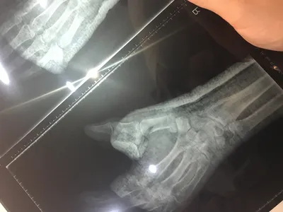 Перелом большого пальца руки: фото из архива медицинских изображений