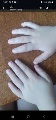 Перелом большого пальца руки: фотография с детальным описанием