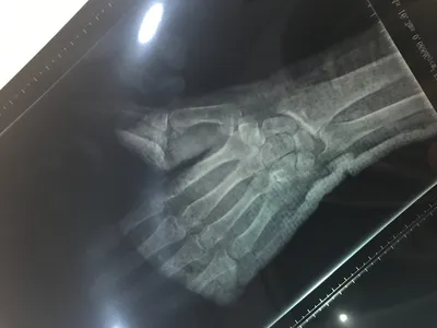 Перелом большого пальца руки: фотография с подробным описанием симптомов