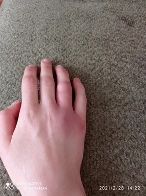 Перелом большого пальца руки: изображение с подробным объяснением симптомов