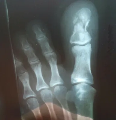 Фотография перелома большого пальца с рентгеновским снимком