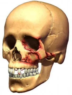 Перелом черепа фото