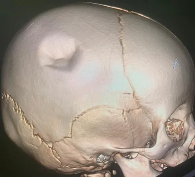 Фото черепа после падения с большой высоты
