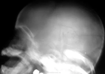 Изображение черепа с переломом в области височной кости