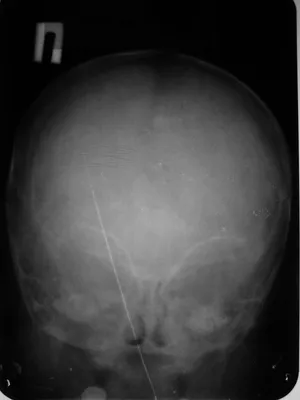 Перелом черепа: фото в формате JPEG