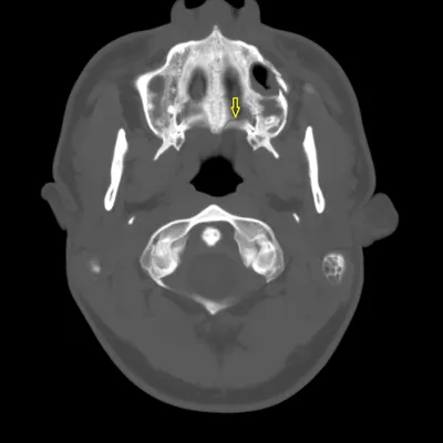 Перелом черепа: фото в формате JPG