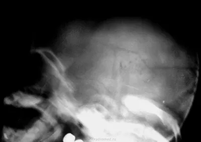Перелом черепа: впечатляющие фотографии в WebP