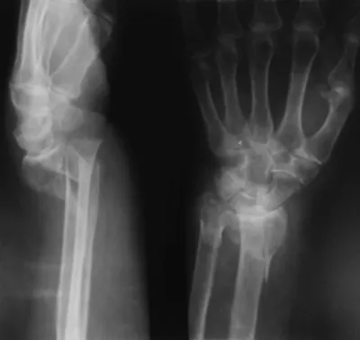 Перелом «луча в типичном месте», или перелом дистального метаэпифиза  лучевой кости, является одним из наиболее частых костных повреждений.… |  Instagram