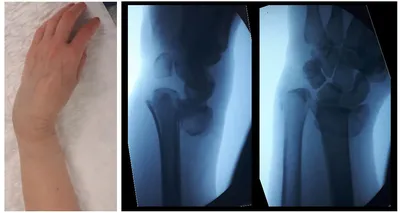 Перелом луча в типичном месте | Фото до и после, операция, отзывы, лечение,  реабилитация и восстановление