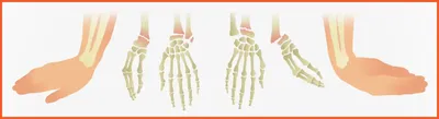 Перелом дистального метаэпифиза лучевой кости (перелом лучевой кости «в типичном  месте») — симптомы, диагностика, лечение в НКЦ№2 (ЦКБ РАН)