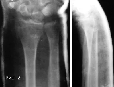 КТ перелом луча в типичном месте - Xray Doctor | Boosty