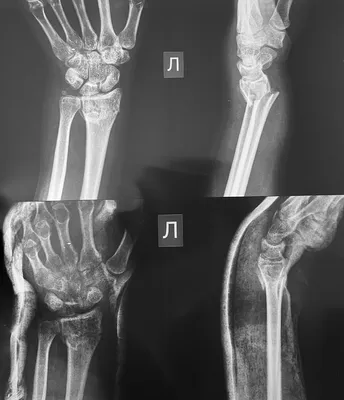 Перелом дистального отдела лучевой кости - KinesioPro