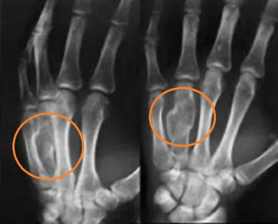 КСС. Травма. Переломы костей предплечья и локтевого сустава. + | Портал  радиологов
