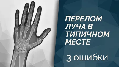 Перелом дистального луча. Семенкин Олег Михайлович. Кистевой хирург.  Хирургия кисти.