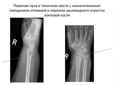 Переломы лучевой кости в типичном месте – тема научной статьи по  клинической медицине читайте бесплатно текст научно-исследовательской  работы в электронной библиотеке КиберЛенинка