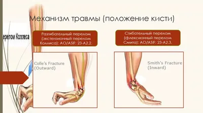 Лечение перелома дистального отдела лучевой кости в Ильинской больнице.