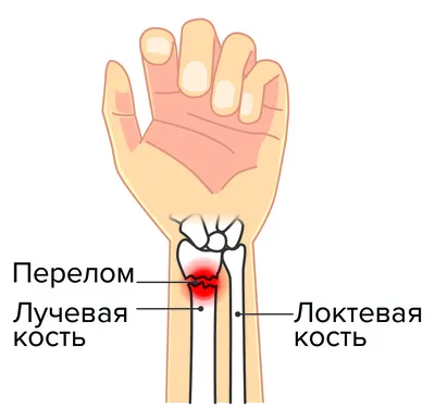 Перелом лучевой кости руки: фото высокого разрешения в формате JPG