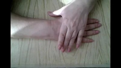 Изображение перелома лучевой кости руки: анатомия руки