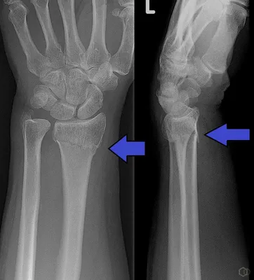 Фото перелома лучевой кости руки: причины и лечение