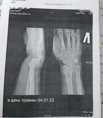 Фотография перелома лучевой кости руки: как лечить дома