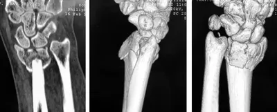 Изображение перелома лучевой кости руки: реабилитация после перелома