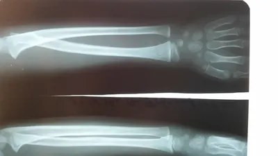Изображение перелома лучевой кости руки: лечение с помощью гипса