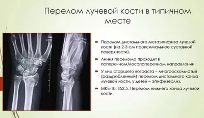 Перелом дистального метаэпифиза лучевой кости (перелом лучевой кости «в типичном  месте») — симптомы, диагностика, лечение в НКЦ№2 (ЦКБ РАН)