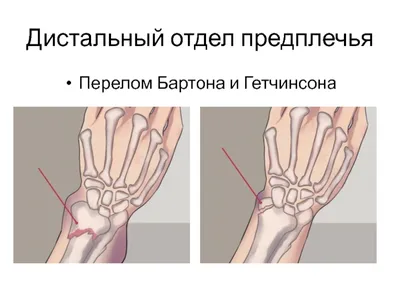 Операция при переломе луча в типичном месте | Фото до и после, операция,  отзывы, лечение, реабилитация и восстановление