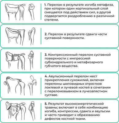 Перелом дистального луча. Семенкин Олег Михайлович. Кистевой хирург.  Хирургия кисти.