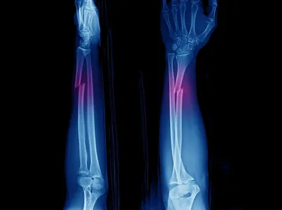 Цена лечения перелома плечевой кости | Записаться к травматологу-ортопеду в  Центр травматологии и ортопедии ГУТА КЛИНИК