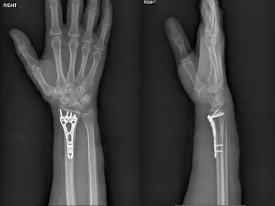 zinnurof - Перелом лучевой кости в типичном месте со... | Facebook