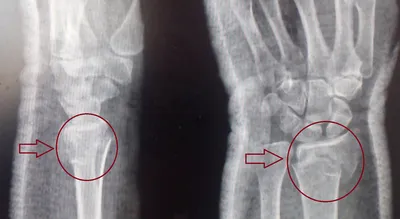 Перелом дистального метаэпифиза лучевой кости (перелом лучевой кости «в типичном  месте») — симптомы, диагностика, лечение в НКЦ№2 (ЦКБ РАН)