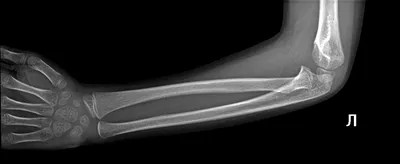 Состояние после перелома лучевой кости в типичном месте и перелом  шиловидного отростка локтевой кости. 🔵 2 месяца рука находилась в  гипсовой... | By doctor.akhmet | Facebook