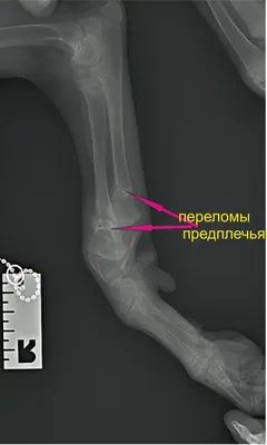 Выбор тактики лечения переломов лучевой кости в типичном месте – тема  научной статьи по клинической медицине читайте бесплатно текст  научно-исследовательской работы в электронной библиотеке КиберЛенинка