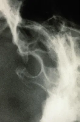 Уникальное изображение перелома основания черепа в формате PNG