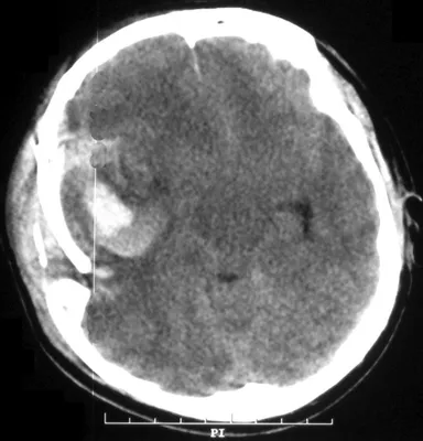 Изображение перелома черепа: подробное описание