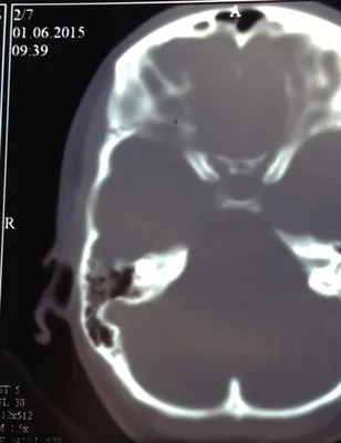 Фото черепа с переломом основания: полное описание травмы