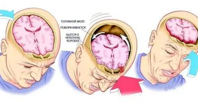 Перелом основания черепа: фотография с детальным описанием