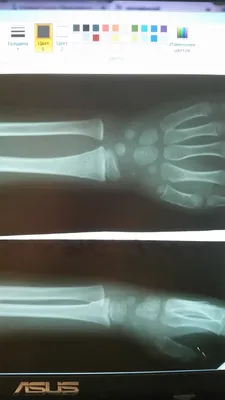 Фото руки с переломом в гипсе