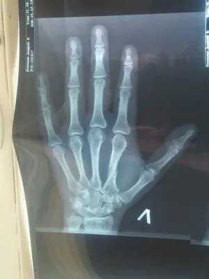 Фото руки с переломом, вызванным спортом