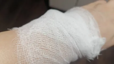 Фотография руки с переломом, вызванным аварией