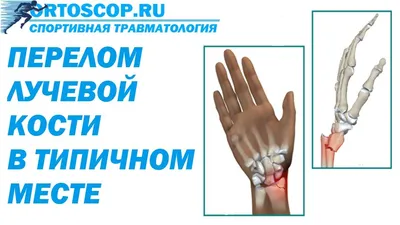 Фотография руки с переломом после операции