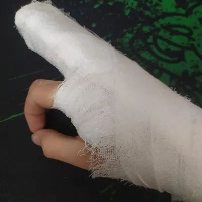 WebP изображение руки с переломом и гипсом
