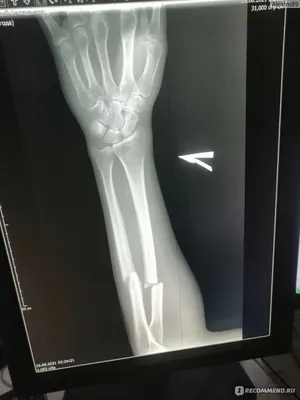 Фотография руки с переломом и гипсом в больничной палате