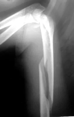 WebP фотография руки с переломом и гипсом