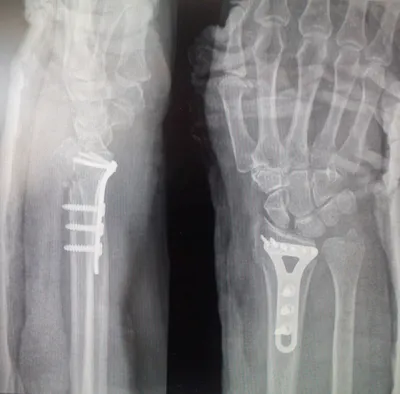 Перелом руки на рентгеновском снимке