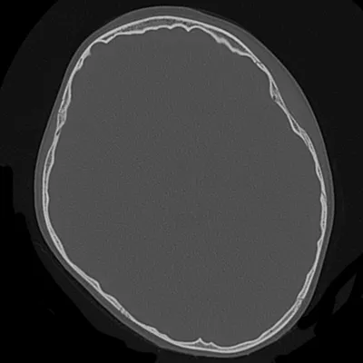 Уникальная фотография перелома свода черепа для медицинских исследований