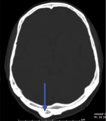 Фото черепа с переломом свода: уникальное изображение для медицинских учебников