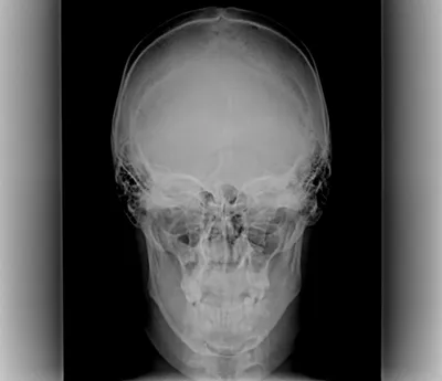 Перелом свода черепа: качественная фотография