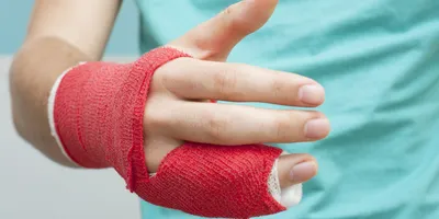 Изображение перелома пальца на руке в формате JPG